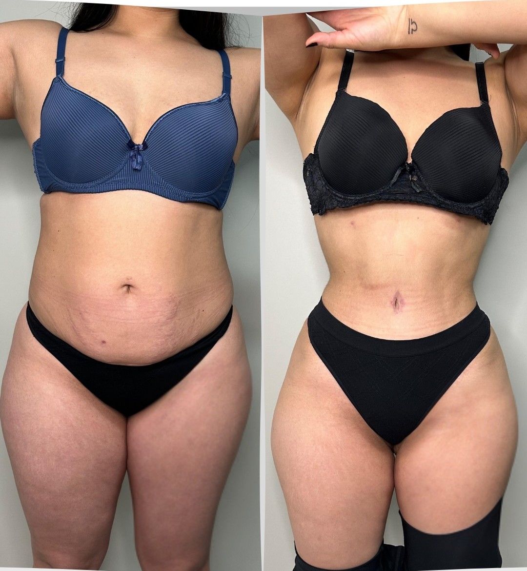 Caso 1: antes y después de frente. Lipoescultura 360°, abdominoplastia y corset muscular.
