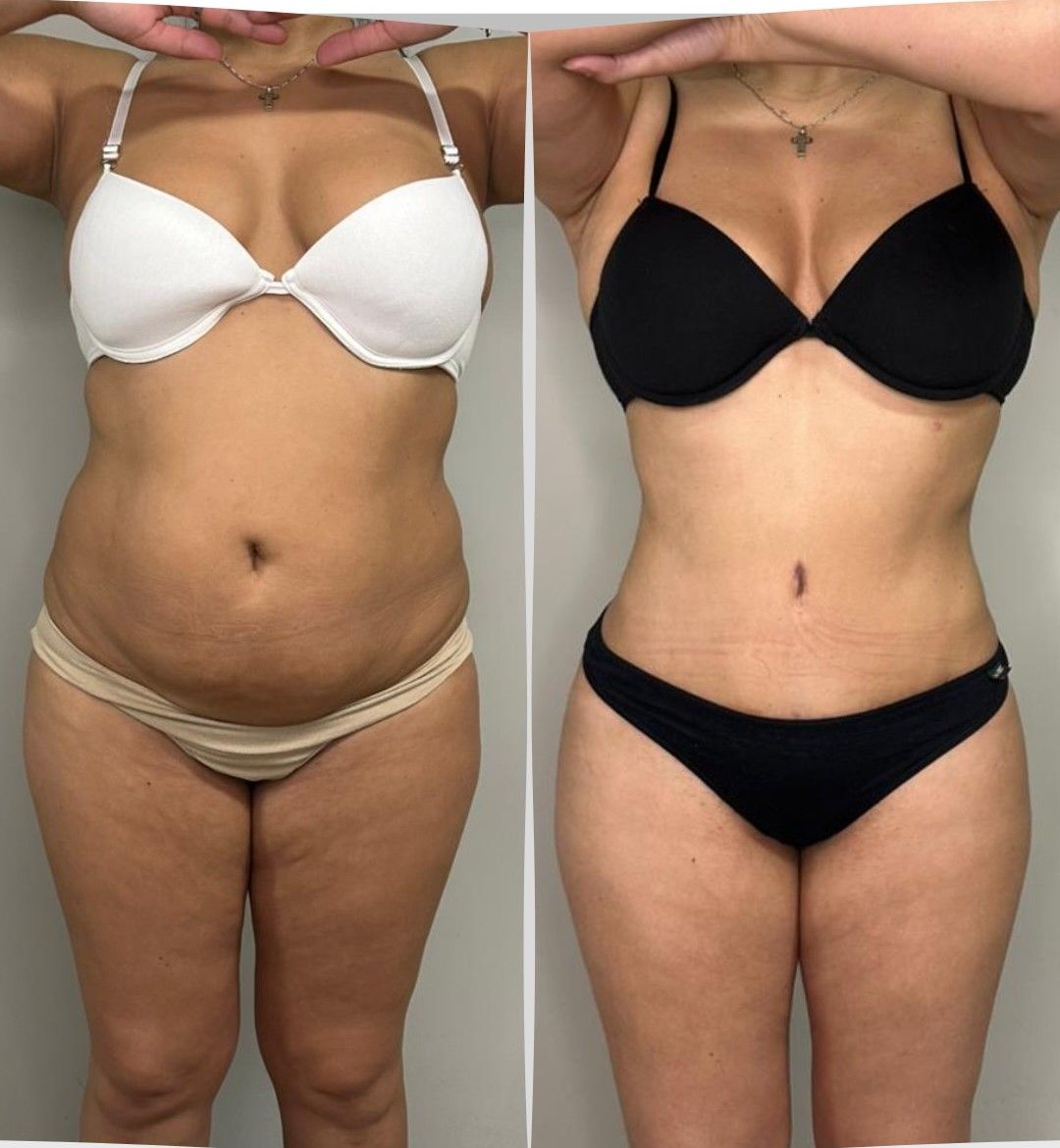 Caso 2: antes y después de frente. Lipoescultura 360°, abdominoplastia y corset muscular.