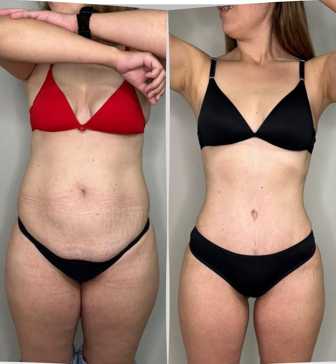 Caso 3: antes y después de frente. Lipoescultura 360°, abdominoplastia y corset muscular.