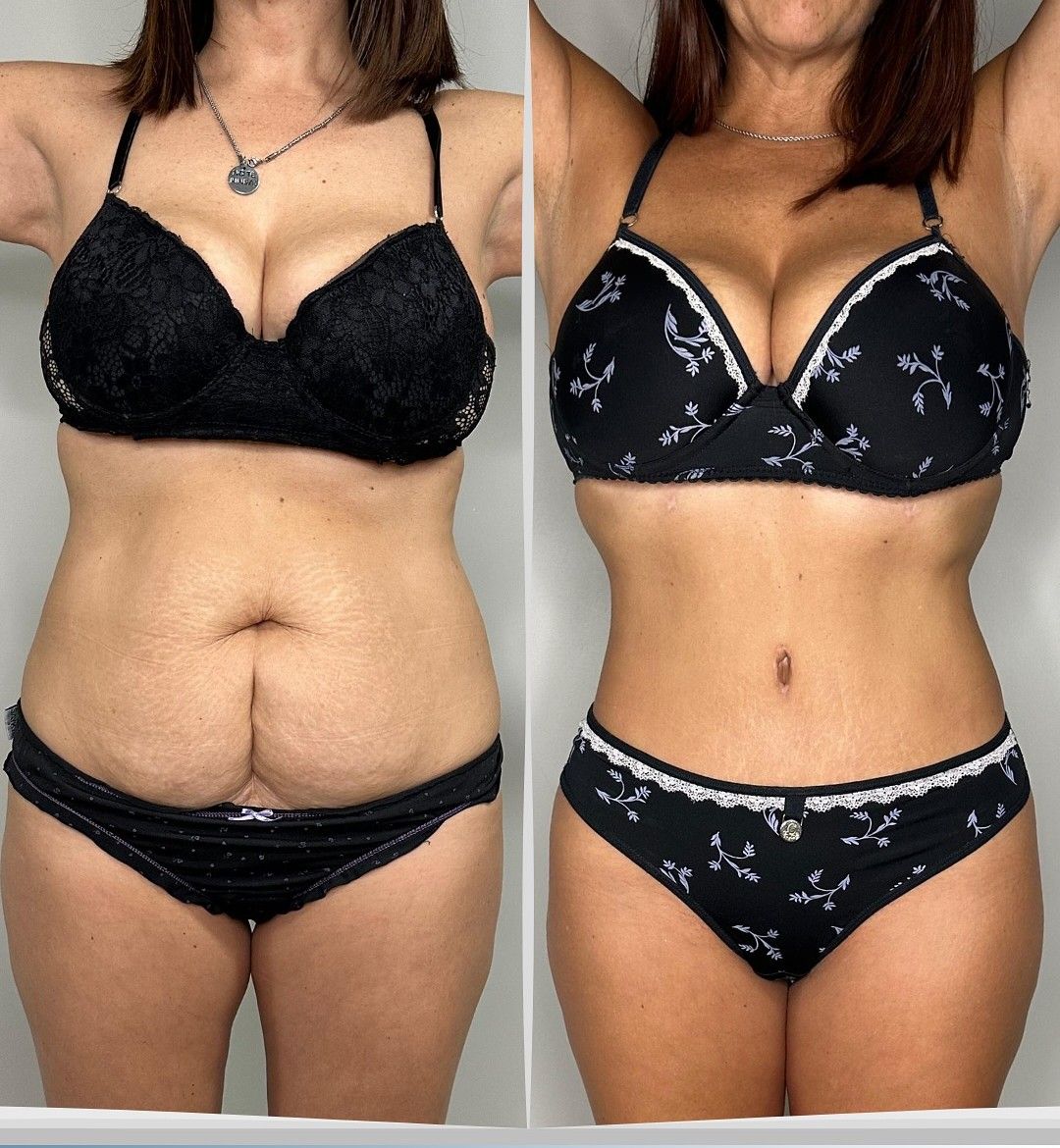 Caso 4: antes y después de frente. Lipoescultura 360°, abdominoplastia y corset muscular.