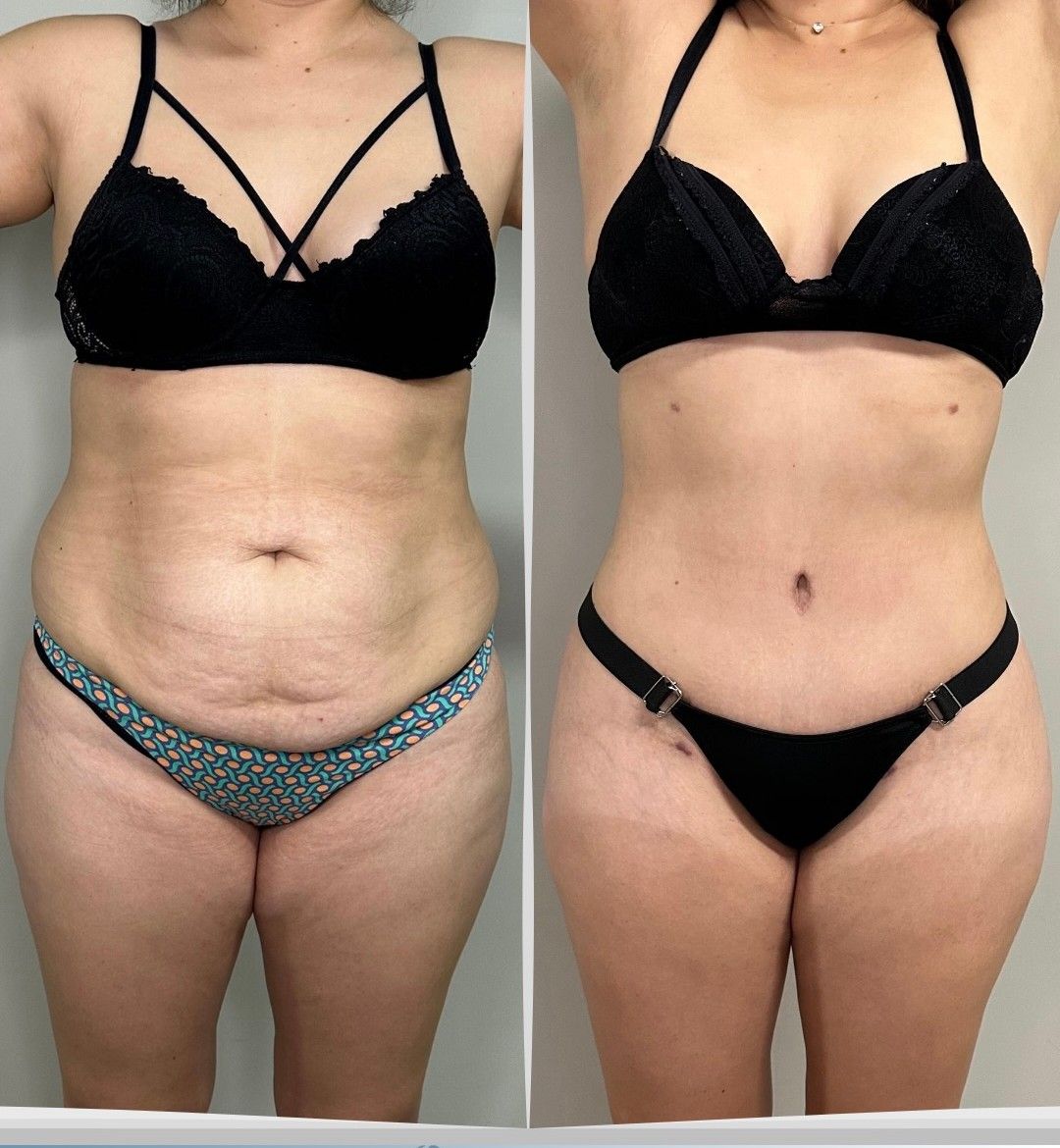 Caso 5: antes y después de frente. Lipoescultura, abdominoplastia con cicatriz extendida y corset muscular.