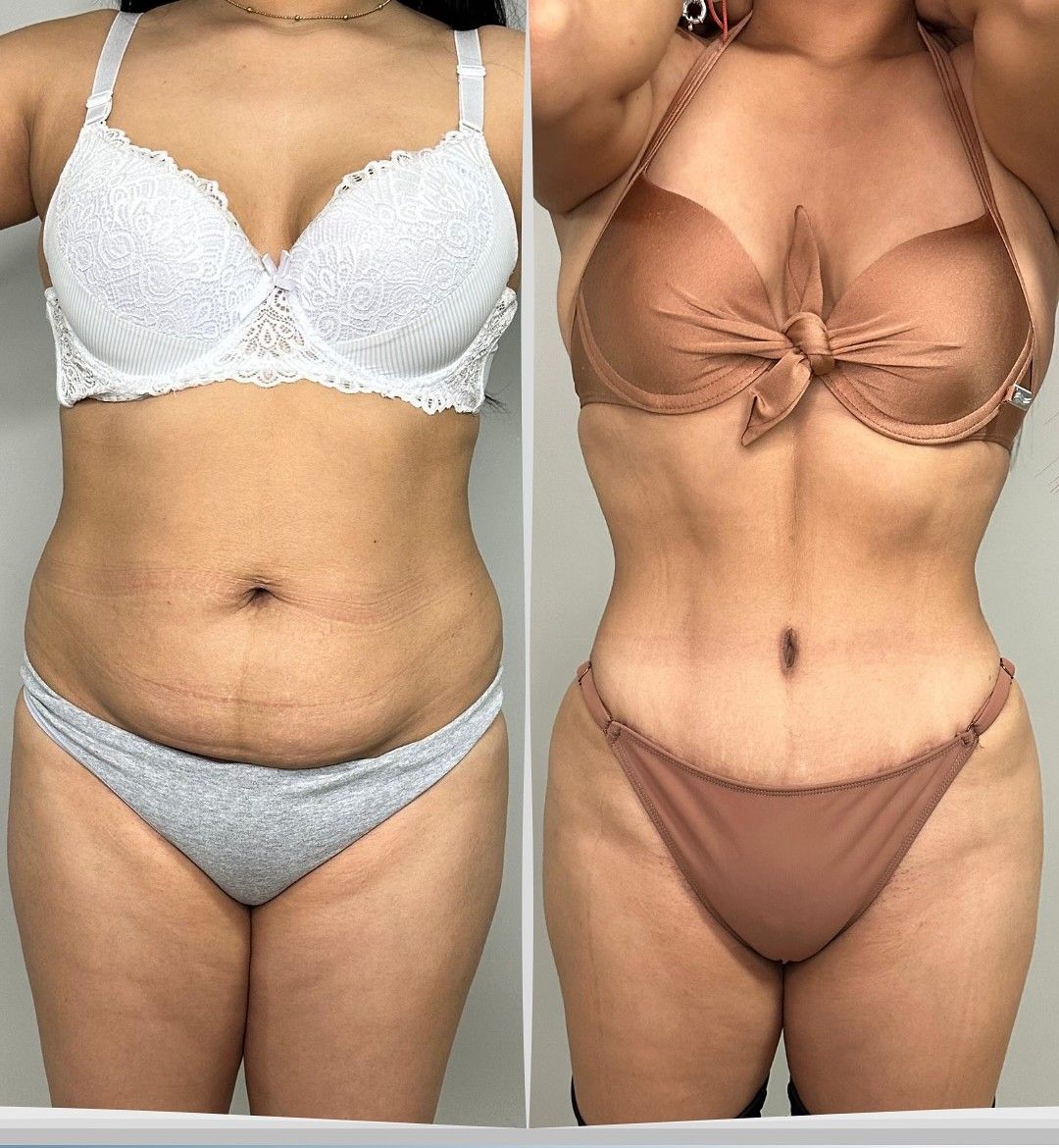 Caso 6: antes y después de frente. Lipoescultura, abdominoplastia, plicatura abdominal e injerto graso en glúteos.
