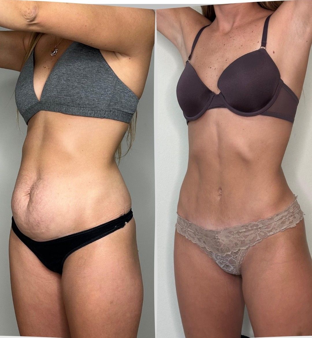 Antes y después de frente de una lipoescultura con abdominoplastia y corset muscular