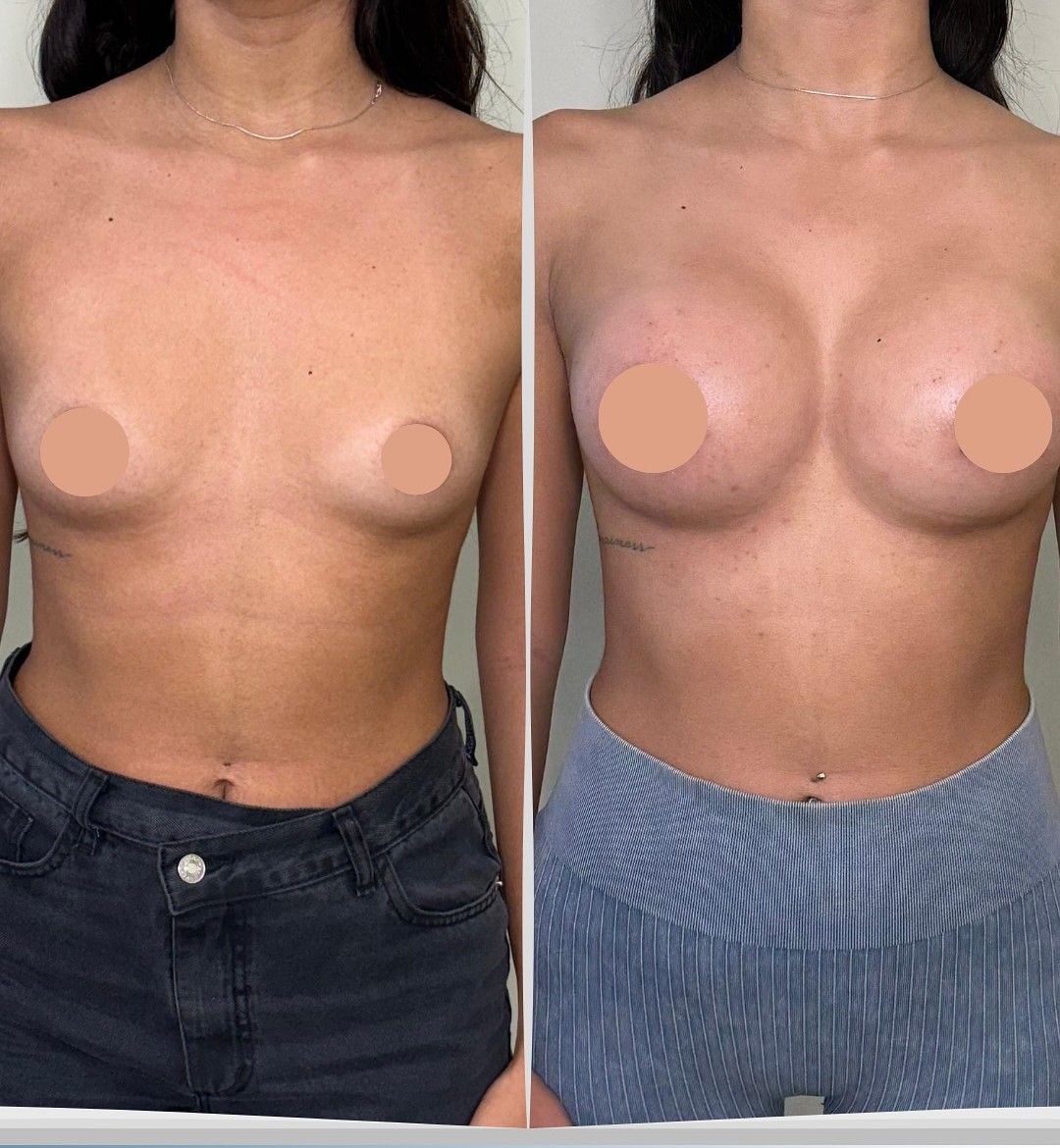 Caso 2: antes y después de frente. Implantes de 400 cc.