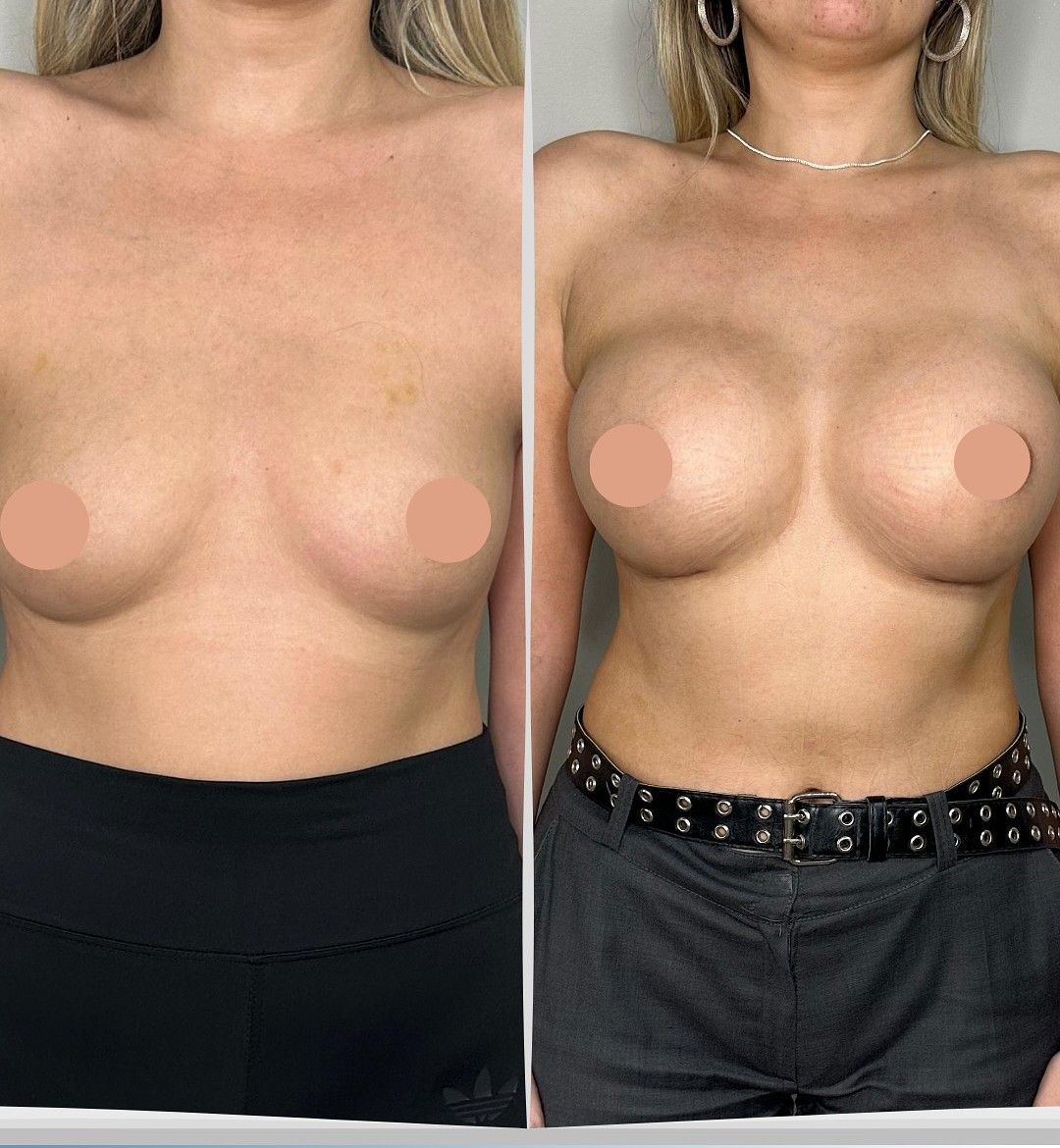 Caso 3: antes y después de frente. Implantes de 375 cc.