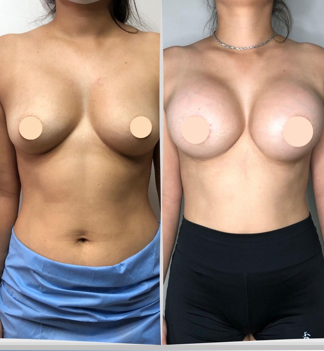 Caso 4: antes y después de frente. Implantes de 350 cc.