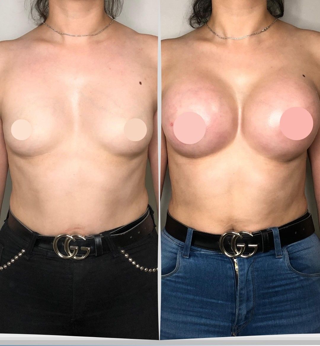 Caso 5: antes y después de frente. Implantes de 325 cc.