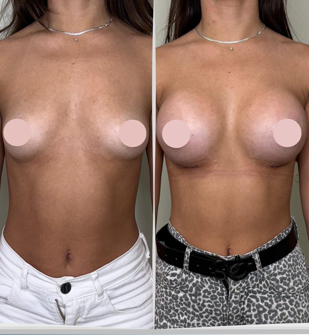 Caso 6: antes y después de frente. Implantes de 300 cc.