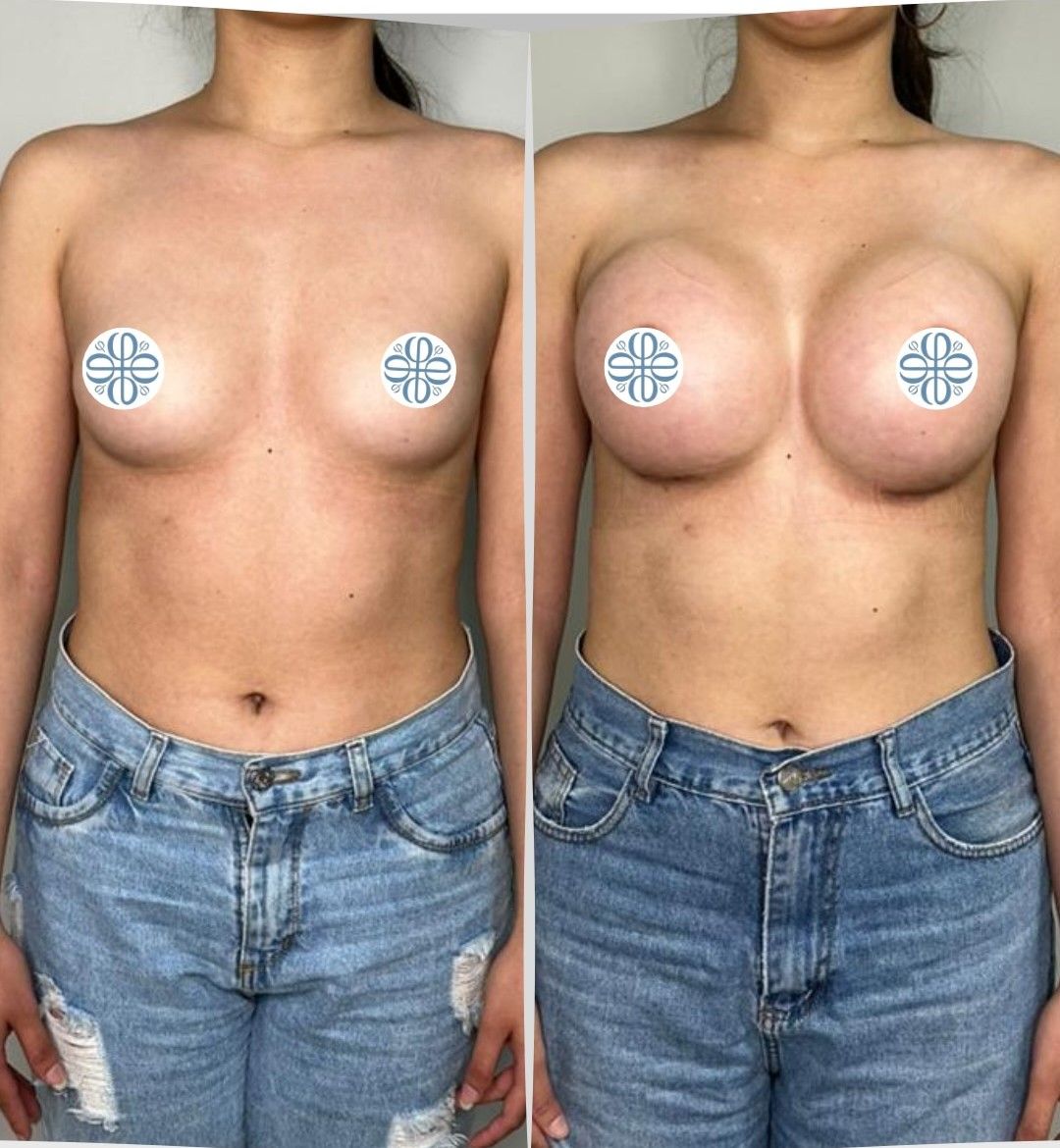 Antes y después de frente de un aumento mamario con implantes de 400 cc