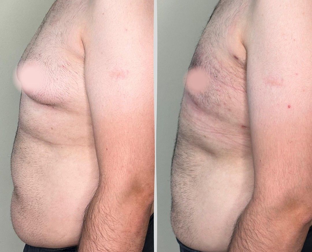 Caso 2: antes y después de perfil. Corrección de ginecomastia.