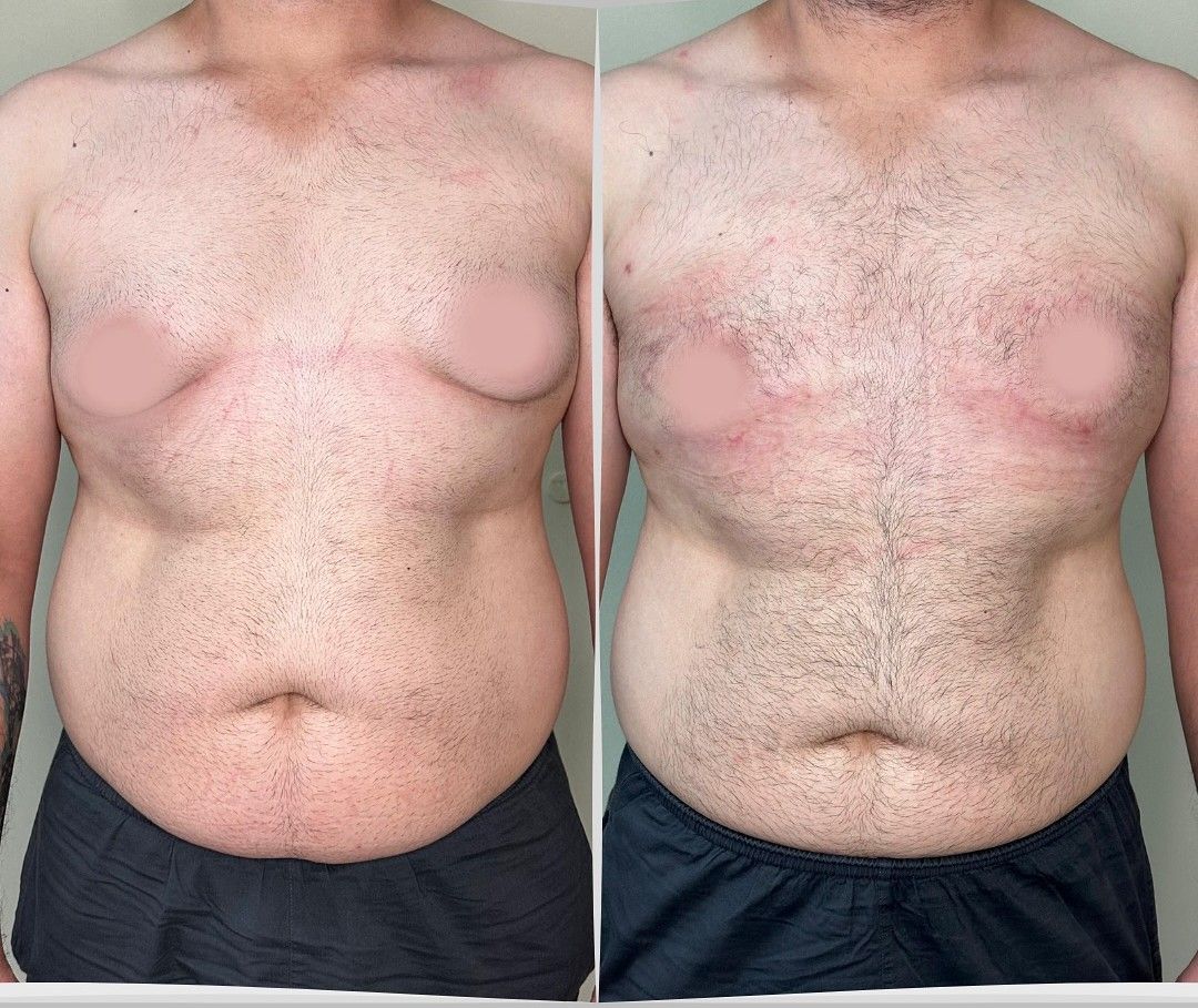 Antes y después de frente de una corrección de ginecomastia