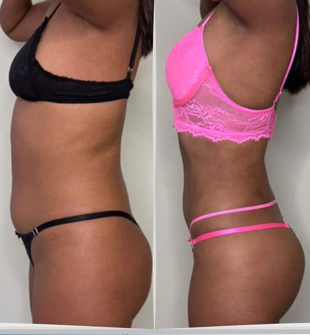Caso 1: antes y después de perfil. Lipoescultura 360°.