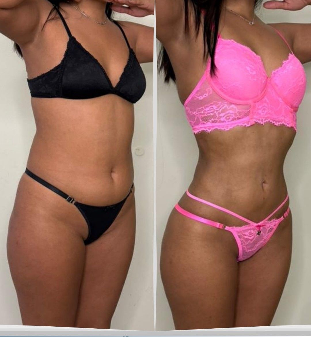 Caso 2: antes y después de tres cuartos. Lipoescultura 360°.