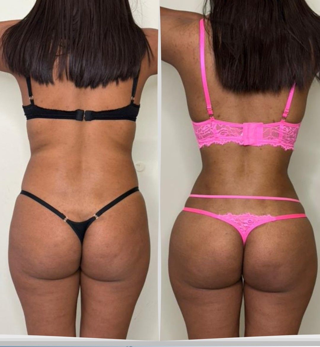 Caso 3: antes y después de espalda. Lipoescultura 360°.