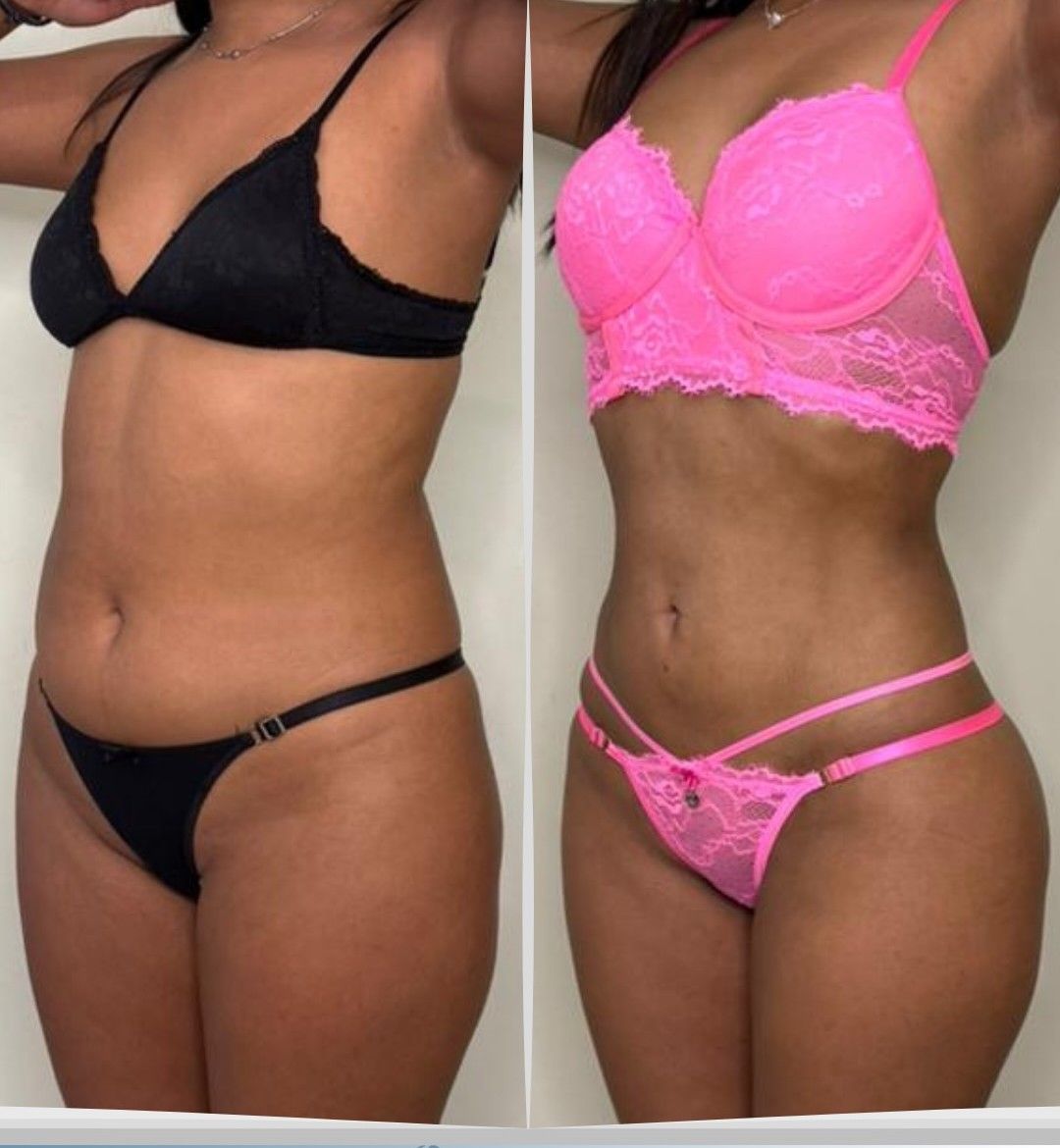 Antes y después de frente de una lipoescultura 360°