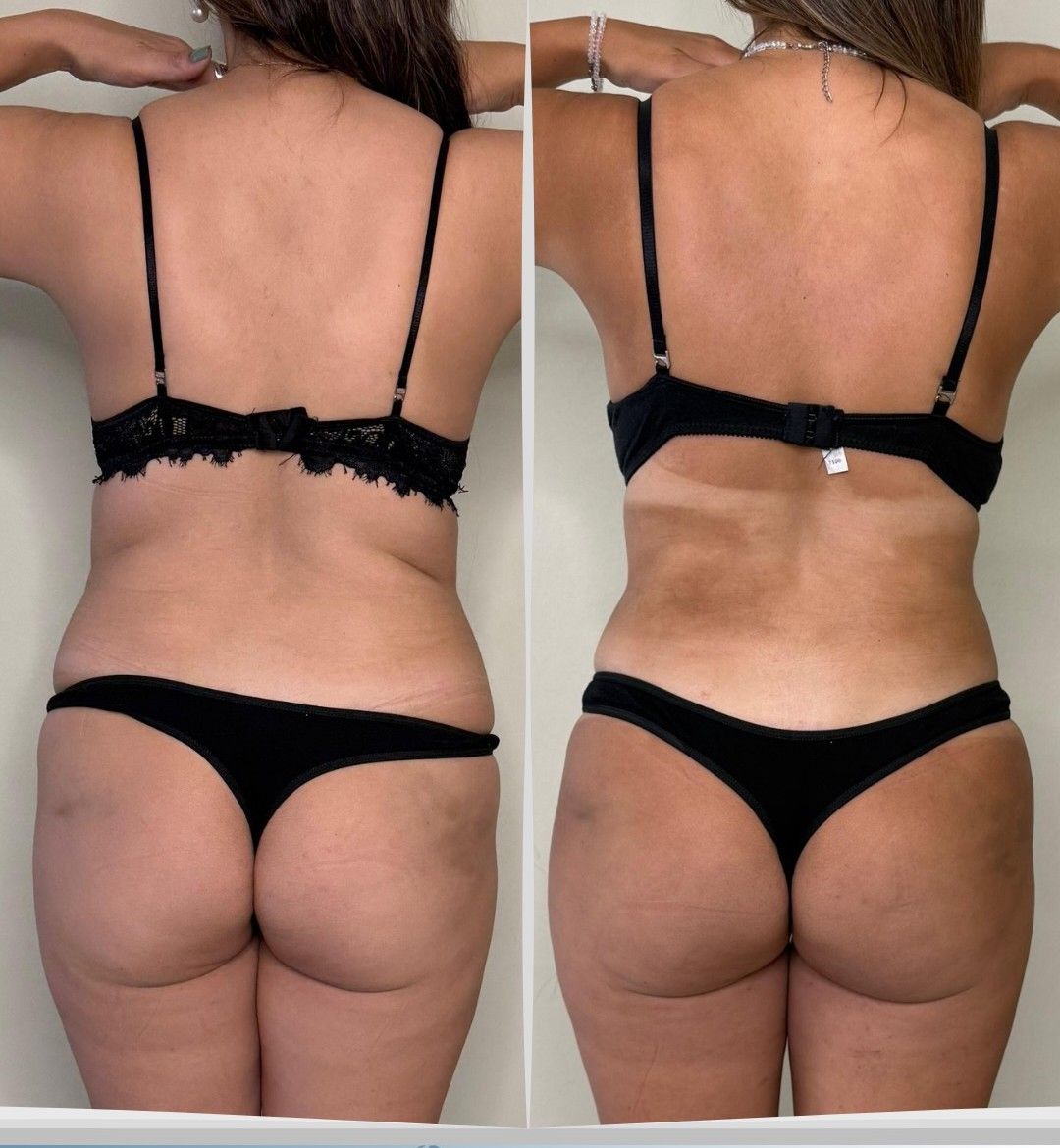 Caso 1: antes y después de espalda. Lipo 360°, abdominoplastia, reparación muscular y transferencia glútea.