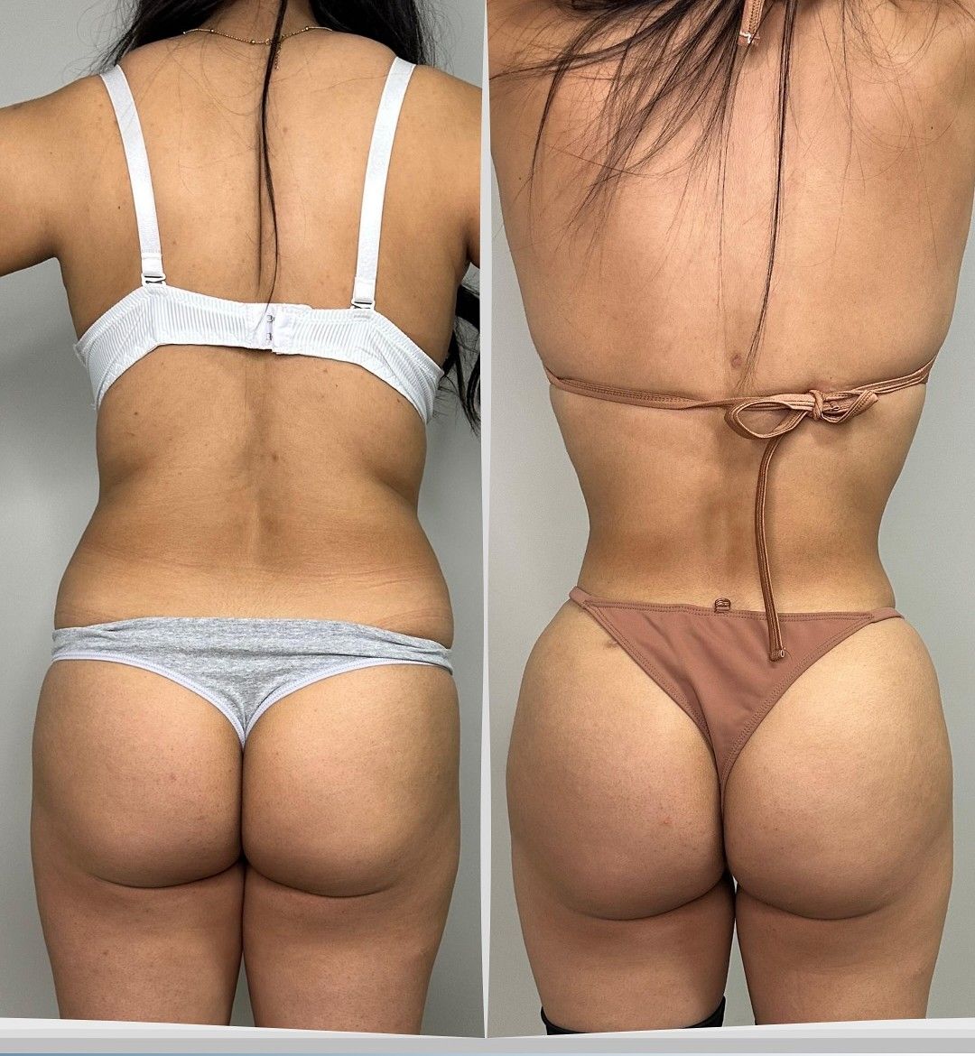 Caso 2: antes y después de espalda. Lipoescultura, abdominoplastia, plicatura abdominal e injerto graso en glúteos.