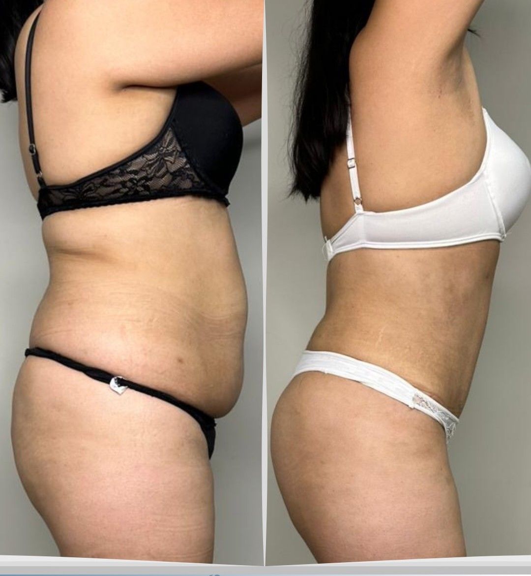 Caso 3: antes y después de perfil. Lipoescultura 360°, abdominoplastia, corset muscular y lipotransferencia glútea.
