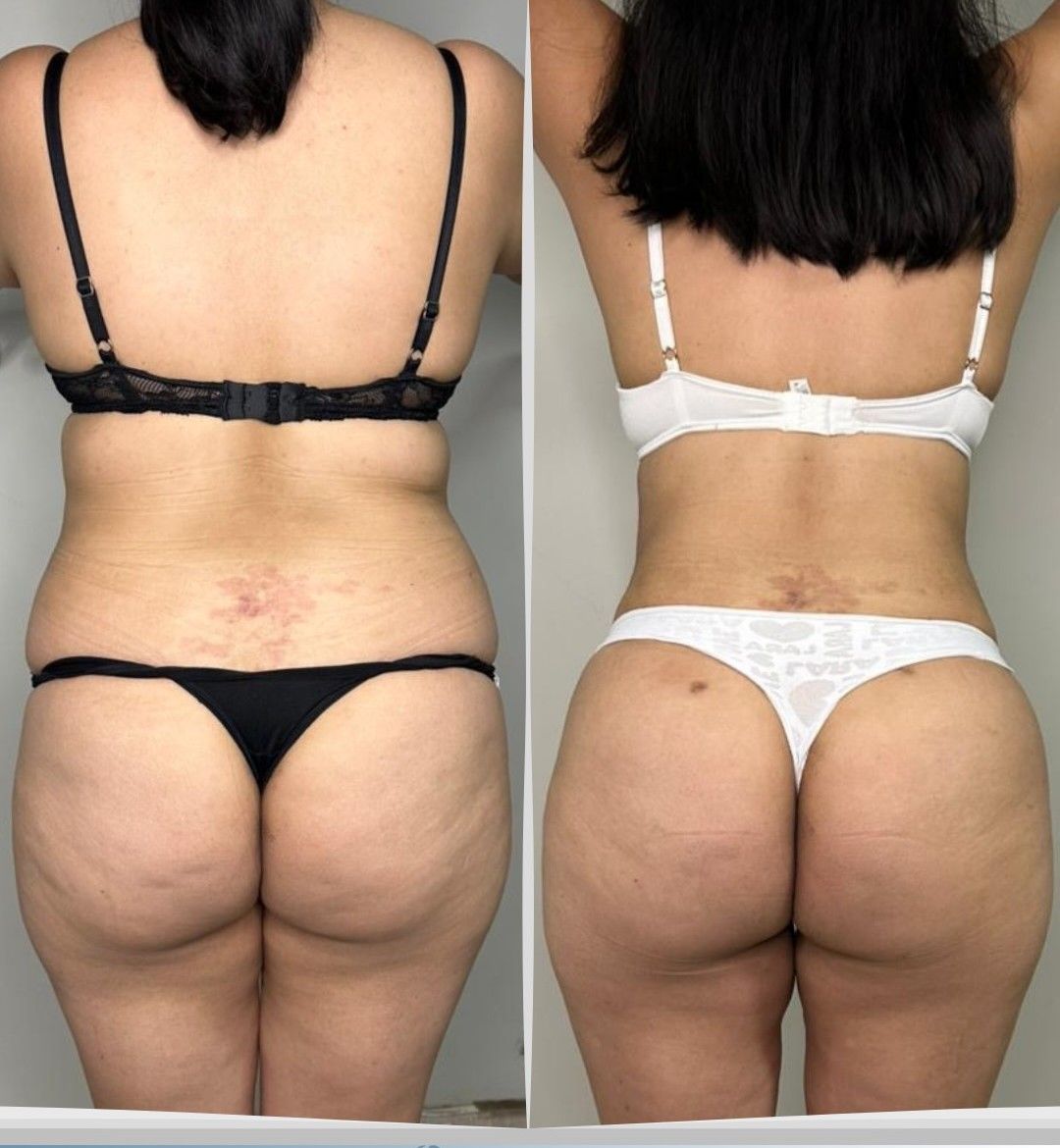 Antes y después de espalda de una lipoescultura con transferencia de grasa a los glúteos