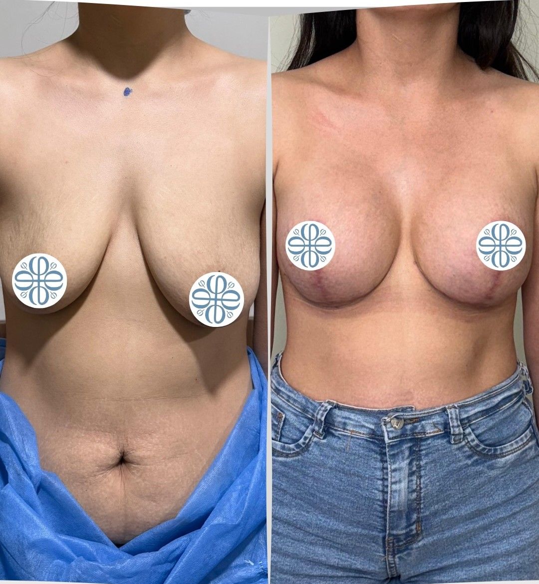 Caso 1: antes y después de frente. Mastopexia con implantes de 350 cc.