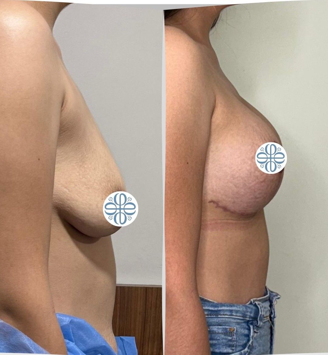 Caso 2: antes y después de perfil. Mastopexia con implantes de 350 cc.