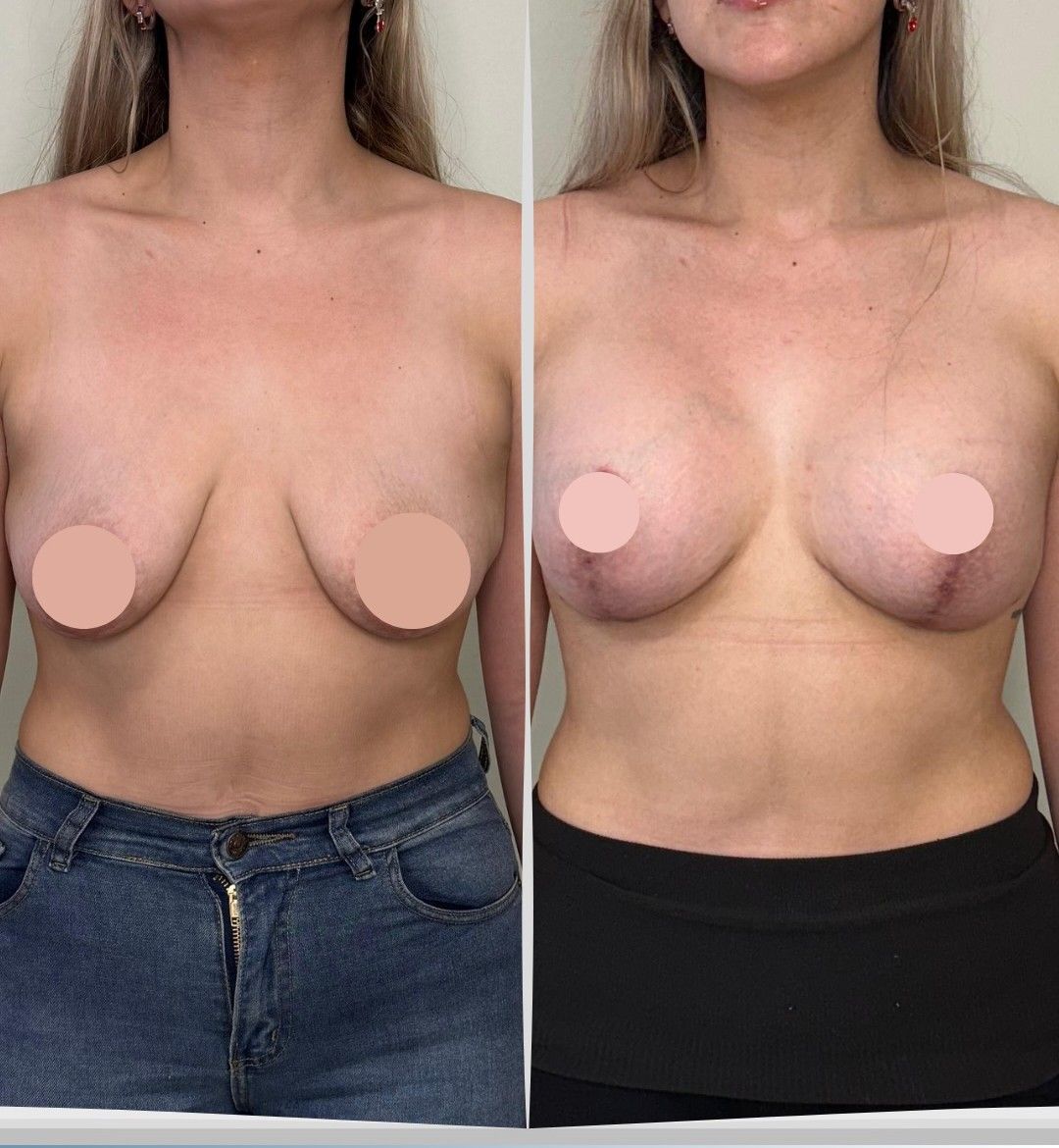 Caso 3: antes y después de frente. Mastopexia con implantes de 325 cc.