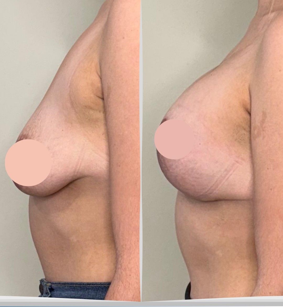 Caso 4: antes y después de perfil. Mastopexia con implantes de 325 cc.