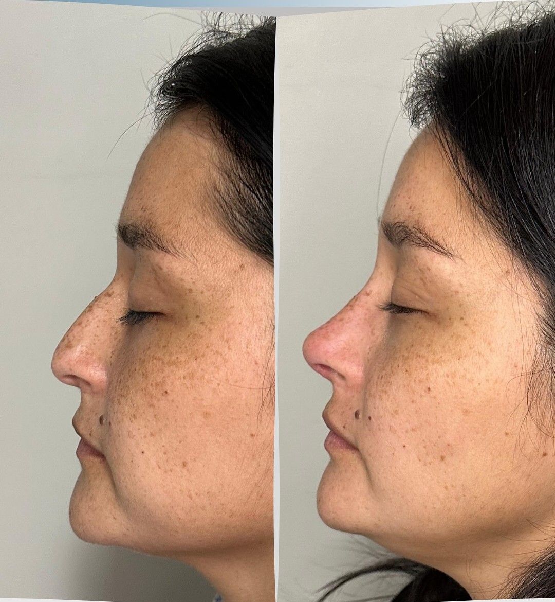 Caso 1: antes y después de perfil. Rinoplastia estructurada.