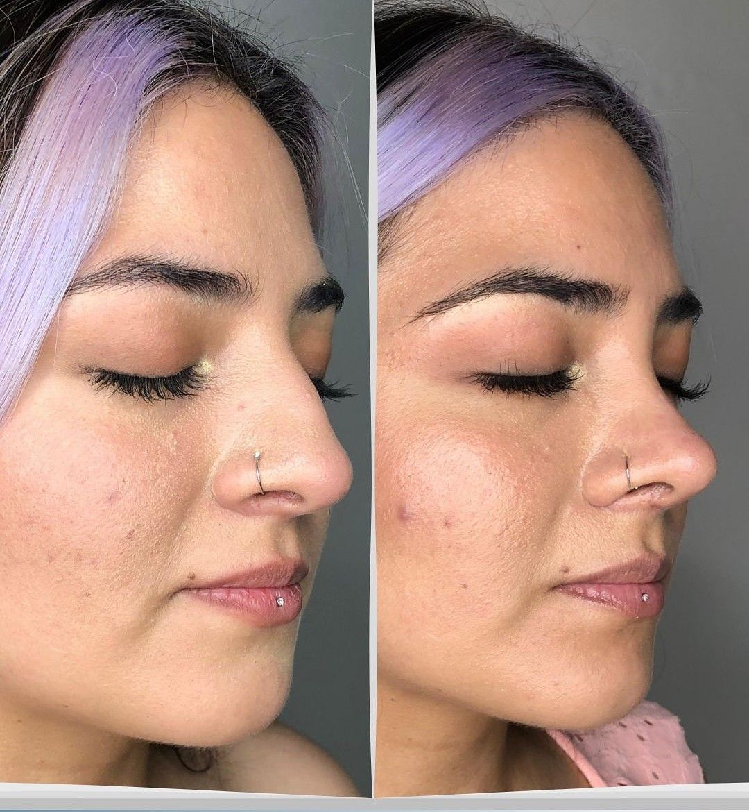 Caso 2: antes y después de perfil. Rinoplastia estructurada.