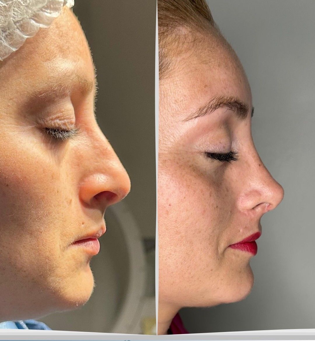 Caso 3: antes y después de perfil. Rinoplastia estructurada.