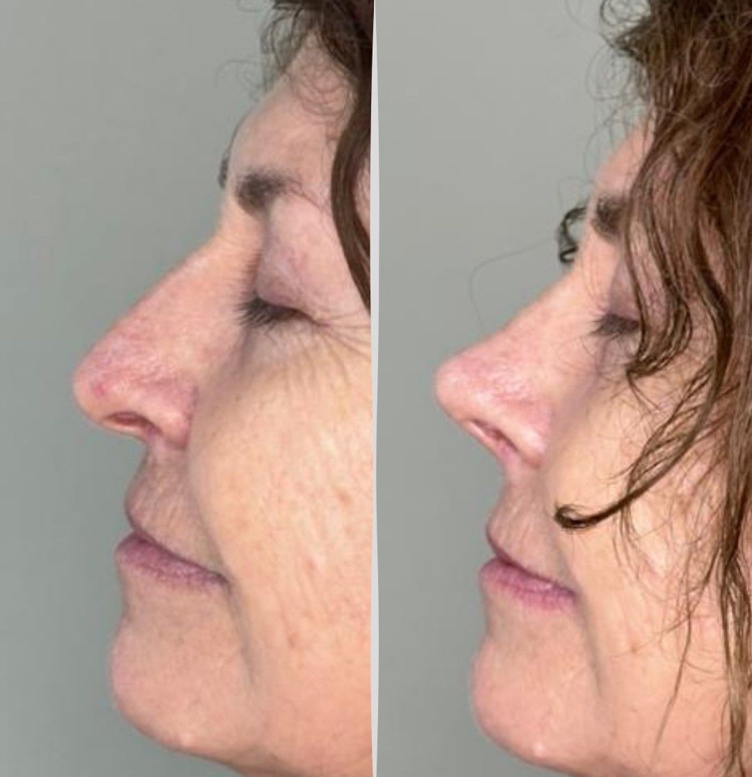Antes y después de perfil de una rinoplastia estructurada
